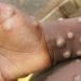Monkeypox infection in humans (credit: Tribuneonline)