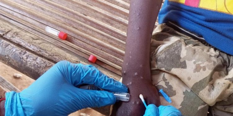 IOM Appeals for USD 18.5 Million to Urgently Aid Mpox-Affected Populations in East, Southern Africa